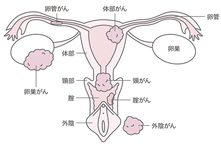 子宮頸がん