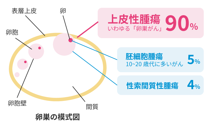 卵巣がん図解