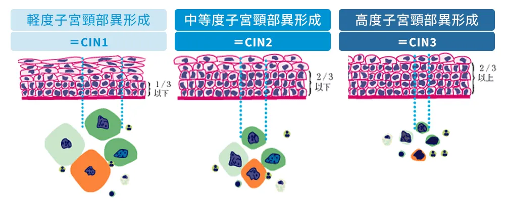 軽度子宮頸部異形成 中等度子宮頸部異形成 高度子宮頸部異形成
