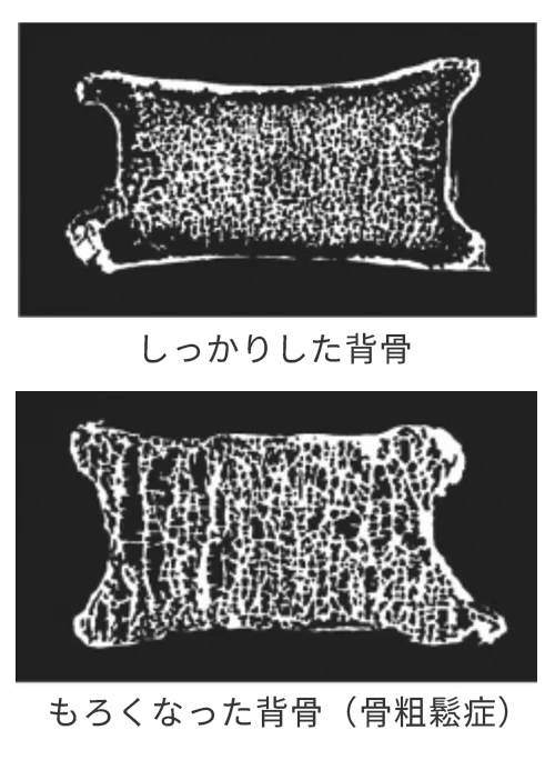 骨粗鬆症 断面図