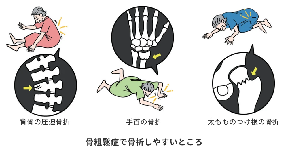 骨折が起こりやすい部位